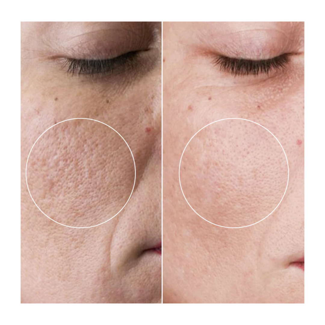 Liorà™ Skin Roller Therapie