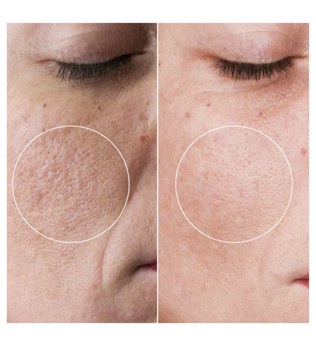 Liorà™ Skin Roller Therapie